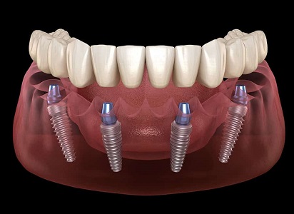 Dental Implant Lucknow